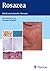 Rosazea.