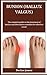 BUNION (HALLUX VALGUS): The...