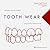 Tooth Wear: Interceptive Treatment Approach With Minimally Invasive Protocols
