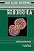 [(Gonorrhea)] [Author: Bria...