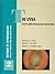 Textbook of Ophthalmology: The Uvea : Uveitis and Intraocular Neoplasms
