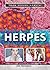 Herpes (Your Sexual Health)