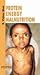 Protein Energy Malnutrition