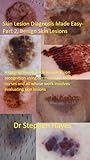 Skin Lesion Diagnosis Made Easy-Part 2, Benign Skin Lesions: A tutorial based guide to non-cancerous skin lesion recognition for GPs, Nurses and all whose ... (Skin Lesion Diagnostics Made Easy) Skin Lesion Diagnosis Made Easy-Part 2, Benign Skin Lesions: A tutorial based guide to non-cancerous skin lesion recognition for GPs, Nurses and all whose ... (Skin Lesion Diagnostics Made Easy)