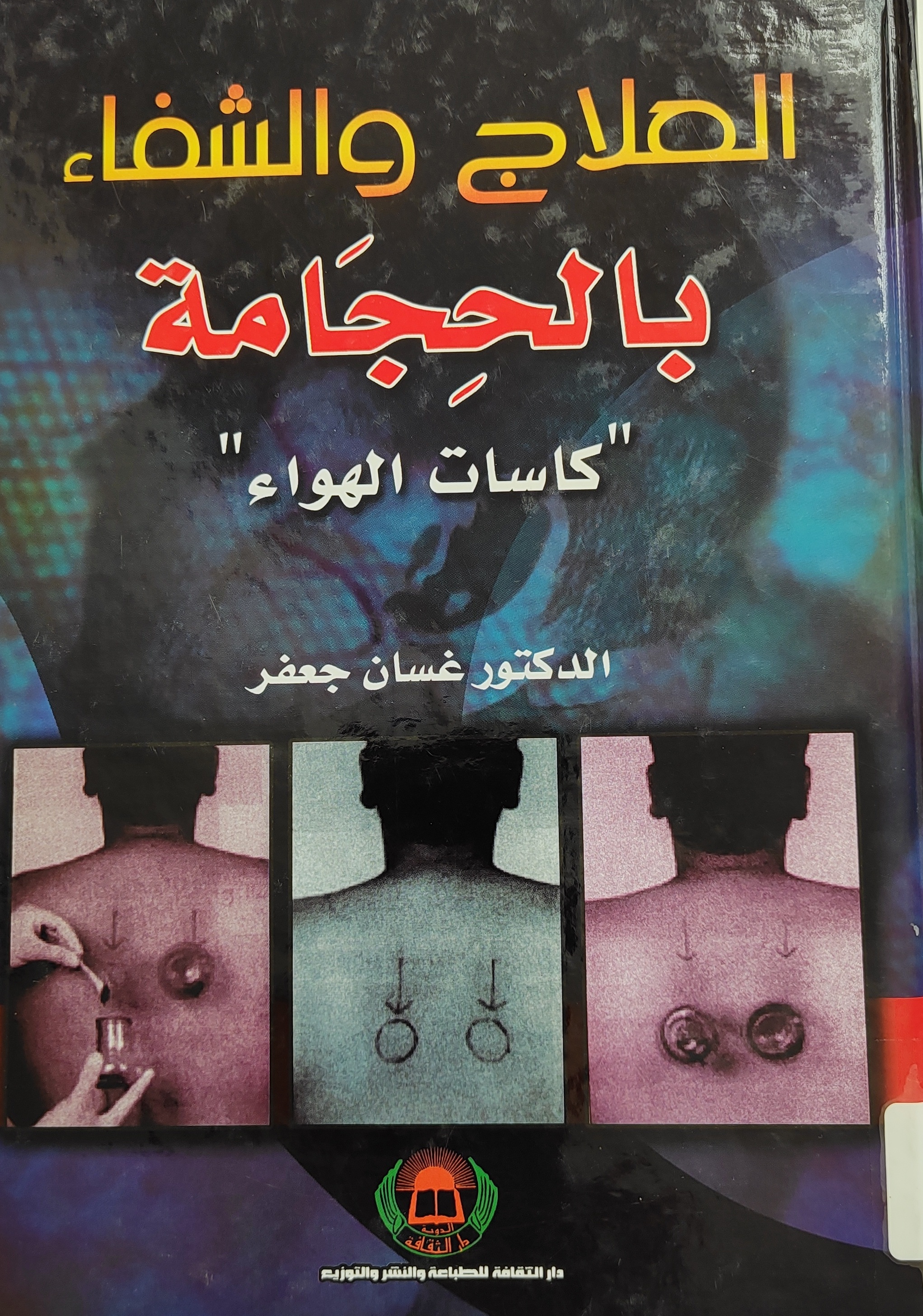 العلاج والشفاء بالحجامة (كاسات الهواء)