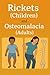 Rickets and Osteomalacia : ...