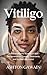 Vitiligo : Understanding the Mystery of Skin Depigmentation, Causes, Treatments, and Its Real-Life Impact