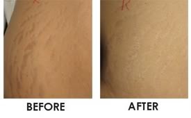 Stretch marks Pictures, Images and Photos