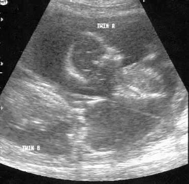Boy girl twins photo: TWINS 1 GIRL, 1 BOY!!!!!!!!! twins.jpg