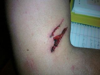 Pete's Wounds