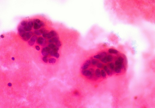 cancer1