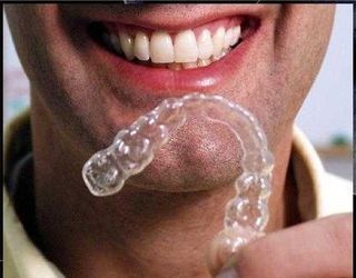 Invisalign-questions
