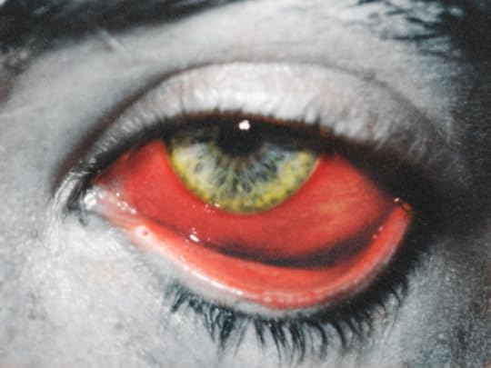 jaundiced eye, eyeball