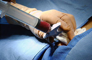 A bone marrow harvest.