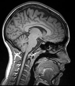 MRI image of the brain