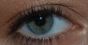 English: Eye with a contact lens (myopia).