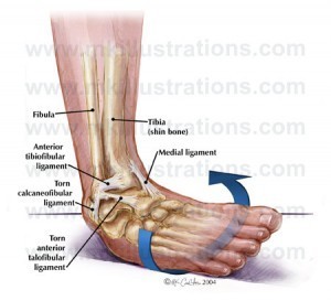 graphic of sprain