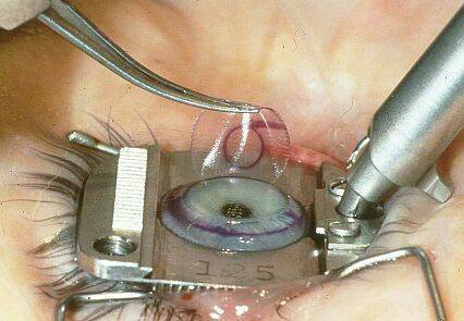 laser-eye-surgery
