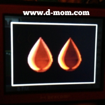 DexCom CGM Calibration