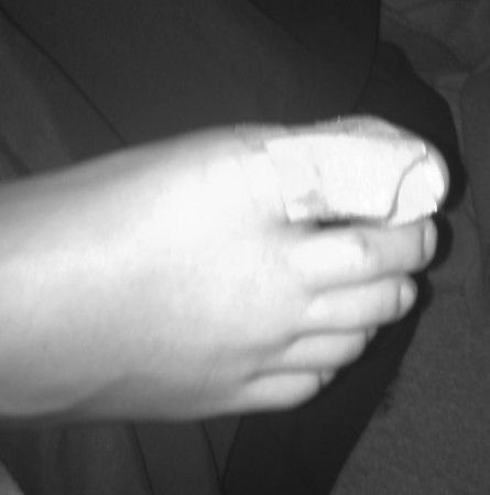 Toe