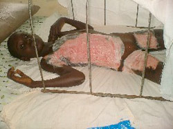 photo of burn patient