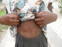 photo of burn patient