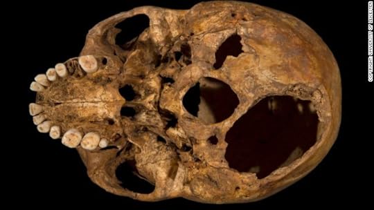 The base of the skull shows the larger of two potentially fatal injuries. This shows clearly how a section of the skull had been sliced off.