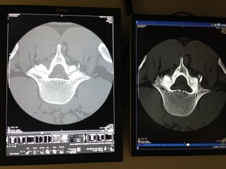 L5 xray