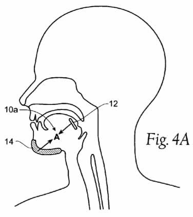 Snoring_Avoidance_Patent