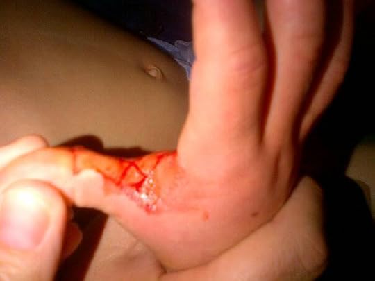 Photo: He bit his hand again! The ABILIFY is NOT working!!!!!!!