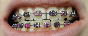 Orthobraces_-_dental_braces_lower_upper_jaw