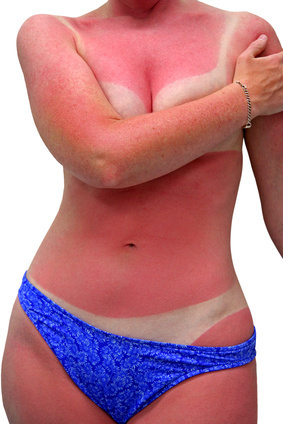 woman with bad sunburn - isolated
