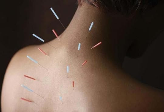 Acupuncture