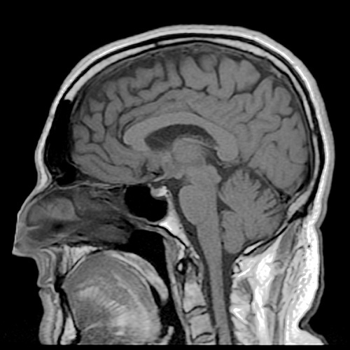 Annotated Sagittal T1 Midline MRI Scan of Reigh's Brain