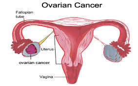 Evito Ramparte Rejects Chemo, Overcomes Ovarian Cancer With Nutrition