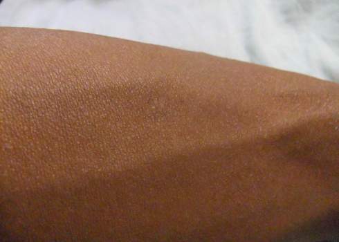 scar