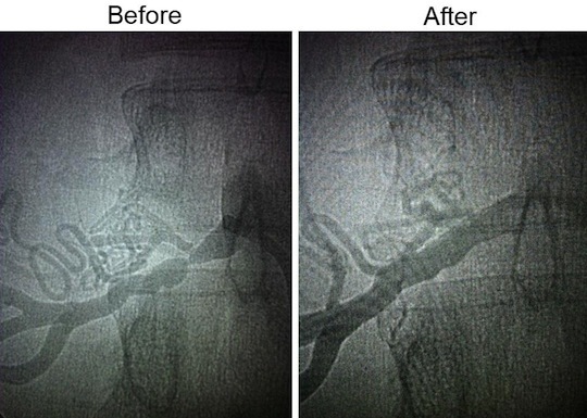 HBAngioplasty 1