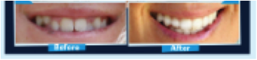 Before & After Damon System Braces