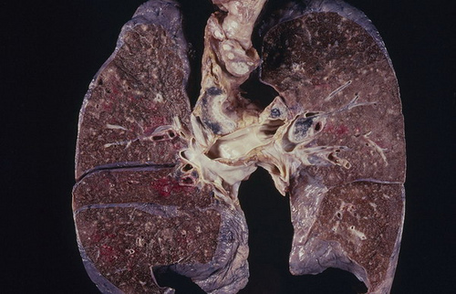 Lung - Miliary tuberculosis