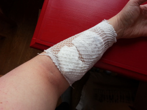 My Arm, soon to be sans IV