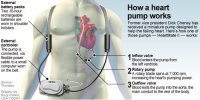 heart-device