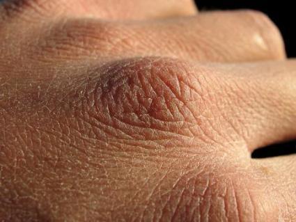 Dry hand