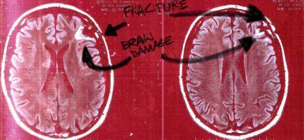 brain