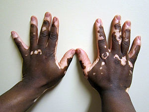 English: Vitiligo of the hand in a person with...