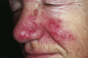 English: Rosacea. Erythema and telangiectasia ...