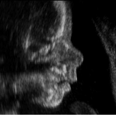 Fetal face profile at 22 weeks. Public domain via Wikimedia Commons. 