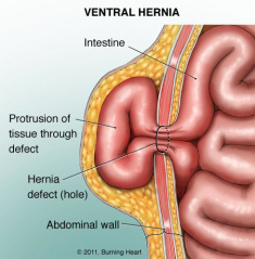 Ventral Hernia