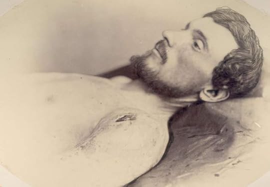 Photograph of John Ruddy taken at Harewood Hospital following his wounding at the South Side Railroad on 2nd April 1865 (National Museum of Health and Medicine)