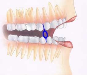 in_mouth