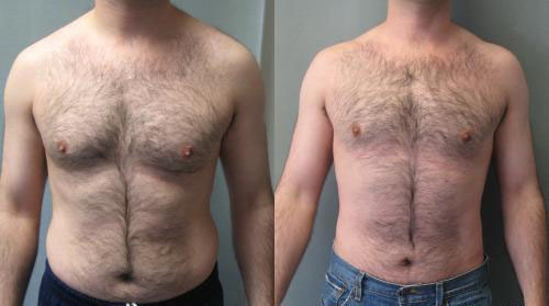 Gynecomastia with Liposuction